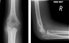 Supracondylar fracture