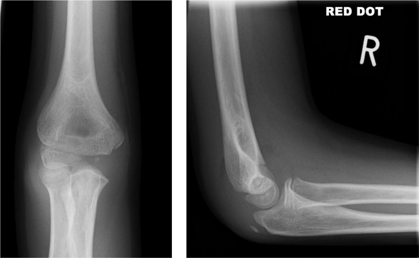 Supracondylar Fracture - Supracondylar Fracture Pediatric Pediatrics Orthob...