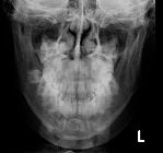 Normal PA mandible