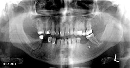 Fracture right body, left coronoid and ramus