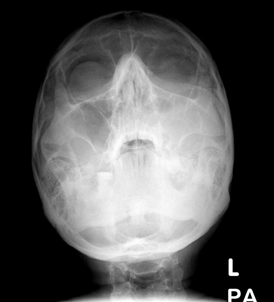 nasal bone x ray anatomy