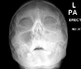 Orbital emphysema - right