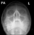 Normal facial bones