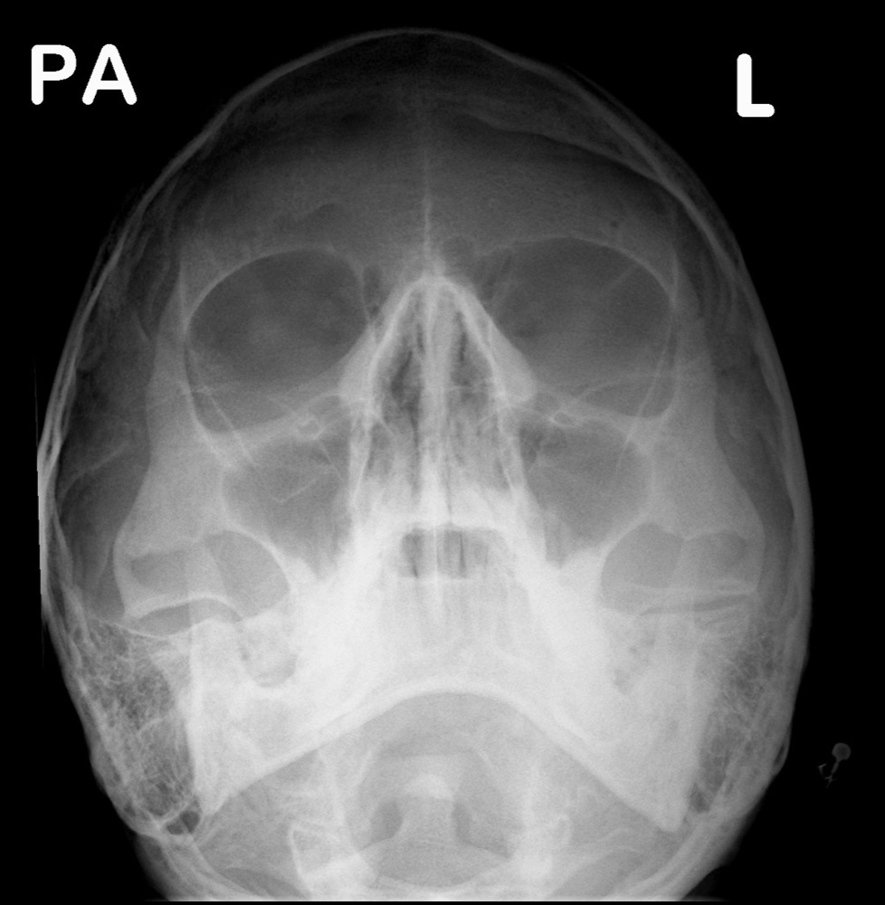 nasal bone x ray anatomy