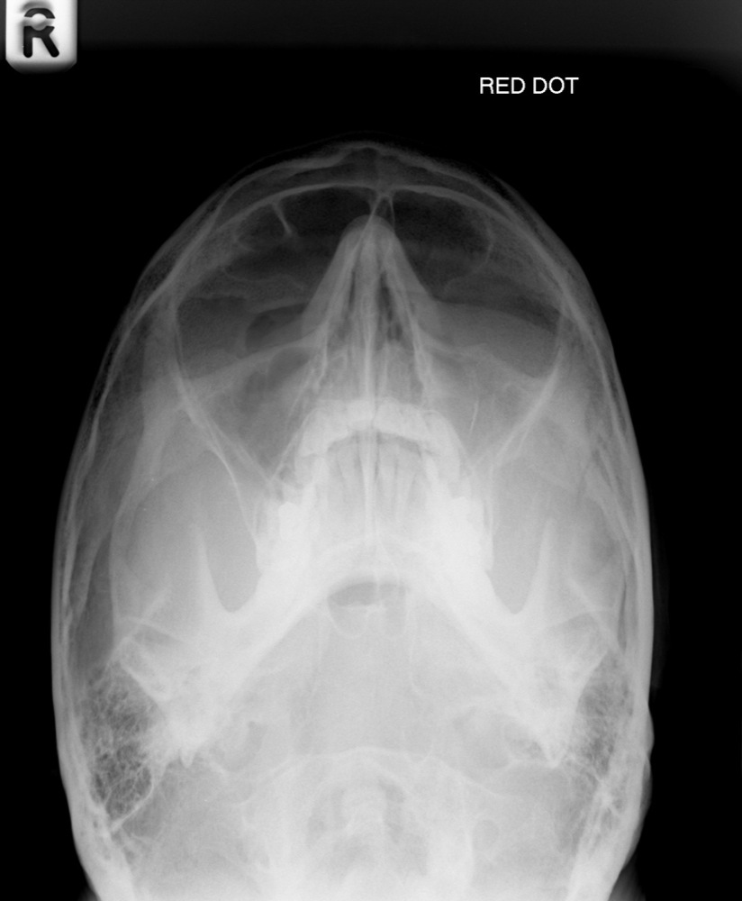 zygomatic bone maxillary process