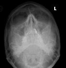 Zygomatic arch fracture - left