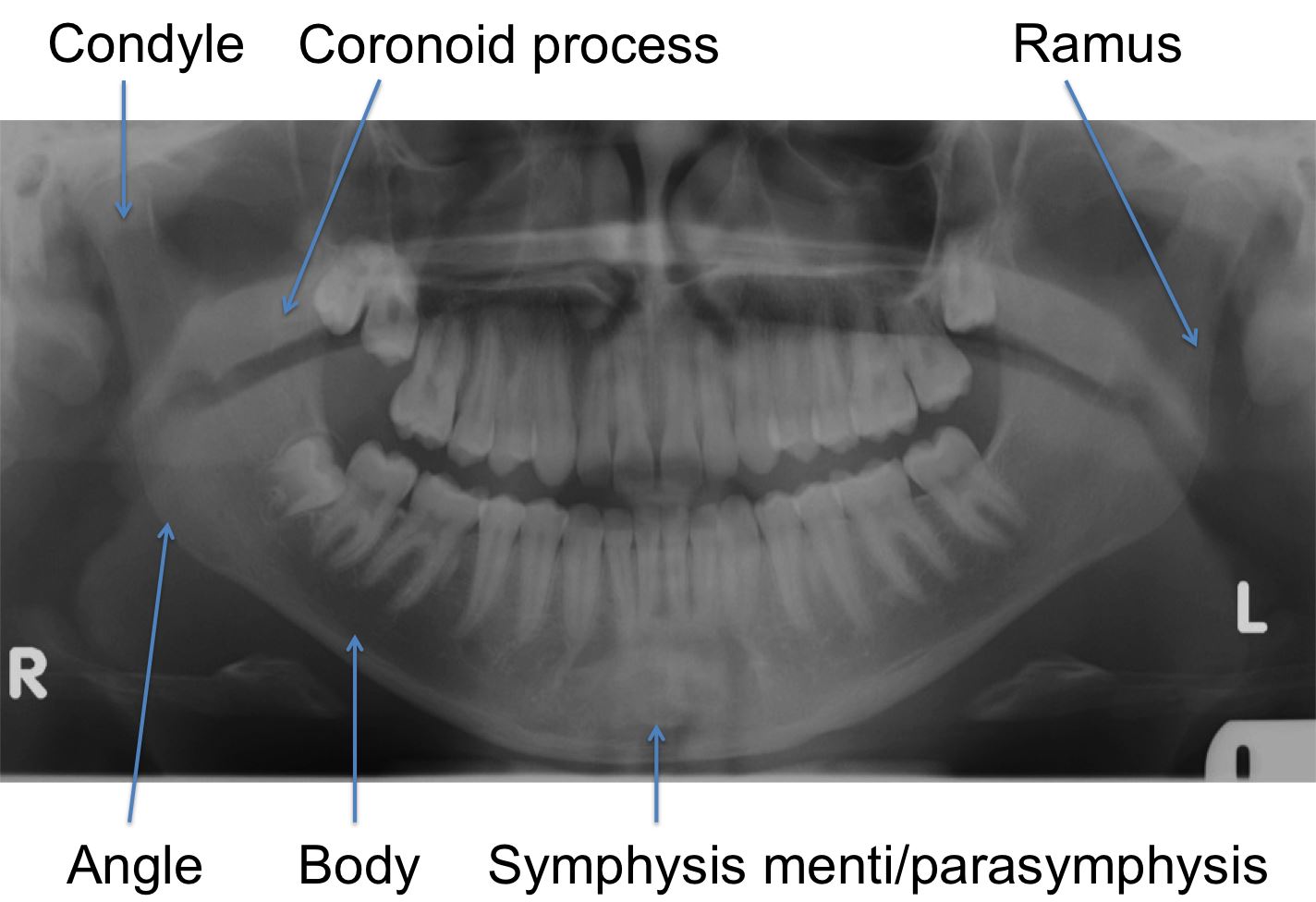 zygomatic bone maxillary process