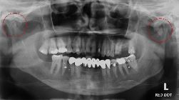 Bilateral condyle fractures