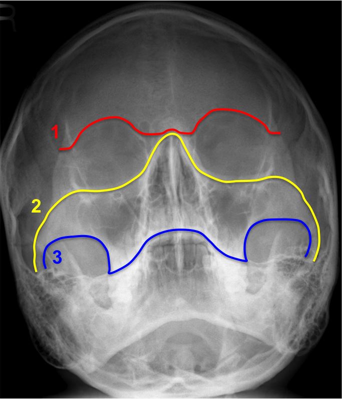 Facial Sutures