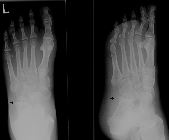 Missed fracture anterolateral calcaneum - 1st attendance