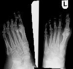 Missed fracture anterolateral calcaneum  - 2nd attendance