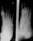 Avulsion anterolateral calcaneum