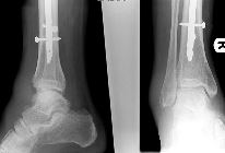 Avulsion dorsal aspect talus, navicular