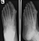 Fracture base 5th metatarsal