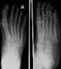 Jones fracture