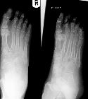 Lisfranc fracture-dislocation