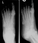 Lisfranc fracture-dislocation