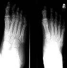 Normal paediatric apophysis