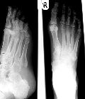 Stress fracture, 3rd metatarsal