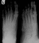 Avulsion anterior process calcaneum