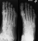 Cuboid avulsion fracture