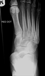 Midtarsal fracture-dislocation