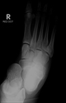 Midtarsal fracture-dislocation
