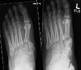 Lisfranc fracture-dislocation