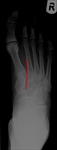 Normal foot alignment