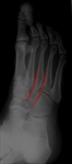 Normal foot alignment