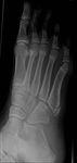 Fracture base 5th metatarsal / normal apophysis