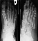 Subtle stress fracture, 2nd metatarsal