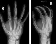 Fractured 4th metacarpal, dislocation 5th carpo-metacarpal joint