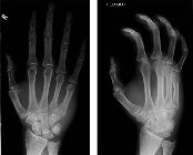 Fracture base 5th metacarpal