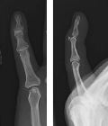 Avulsion fracture at insertion of extensor tendon