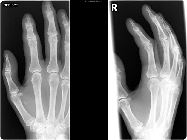 Volar plate avulsion fracture of index finger ... no lateral