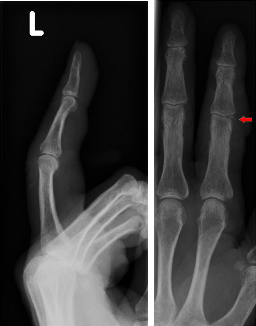 avulsion fracture avulsion fracture