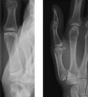 Bennett's fracture-dislocation