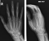 Fracture distal shaft 5th metacarpal