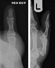 Rolando's fracture-dislocation