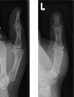 Avulsion fracture at insertion of ulnar collateral ligament