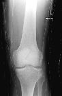 Bipartite patella plus fractured patella