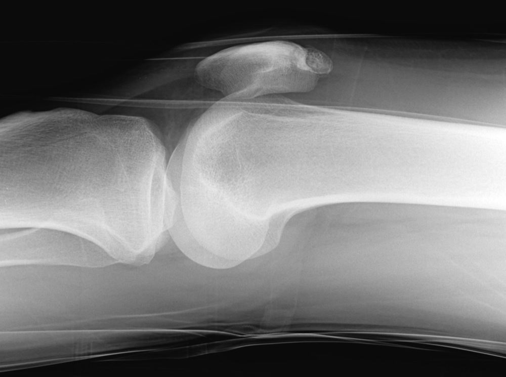 Longitudinal Patella Fracture