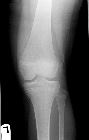 Lateral subluxation patella