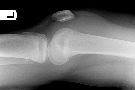 Lateral subluxation patella plus lipohaemarthrosis