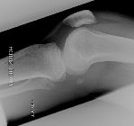 Fracture fibular head plus liphaemarthrosis