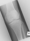 Fracture fibular head