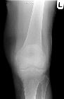 Displaced fracture patella