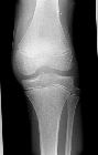 Undisplaced fracture patella