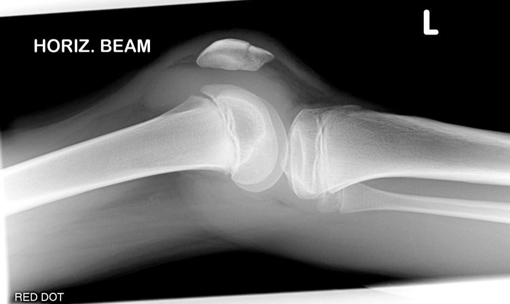 Трещина в коленной. Перелом коленного сустава рентген. Перелом коленной чашечки рентген. Перелом лучевой кости рентген.
